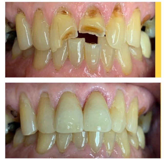 Composite or “Tooth Colored” Fillings - Albany